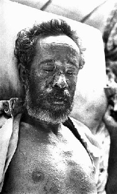 Man with Severe Hemorrhagic Smallpox